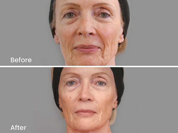 before after ellanse