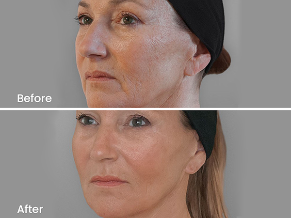 before after ellanse 2