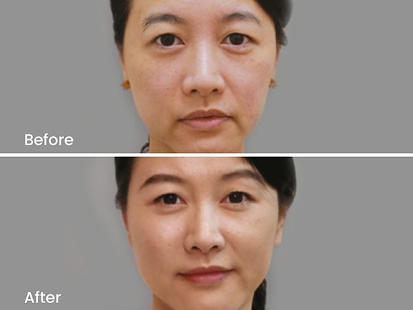 before after ellanse 3