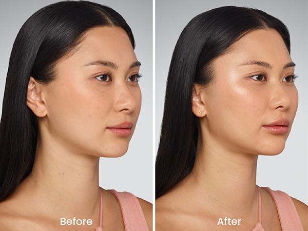 before after juvederm 1
