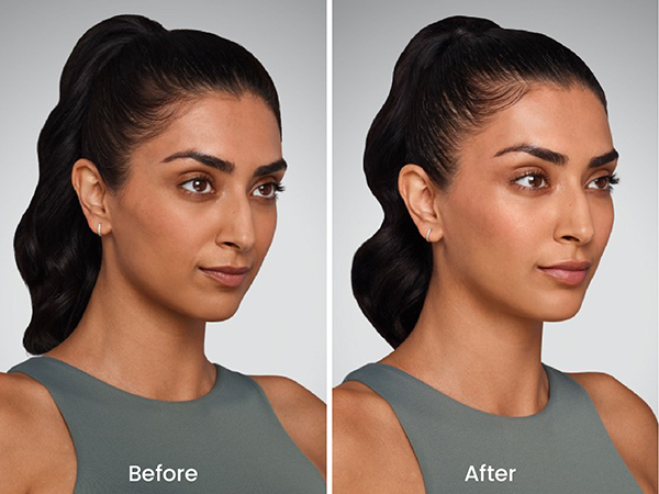 before after juvederm 2