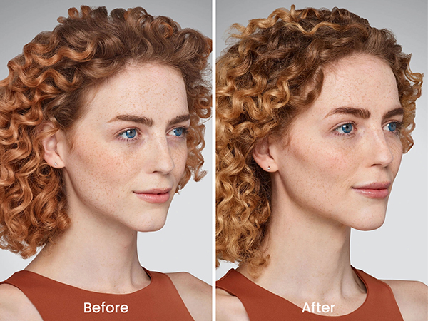 before after juvederm 3