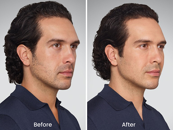 before after juvederm 4