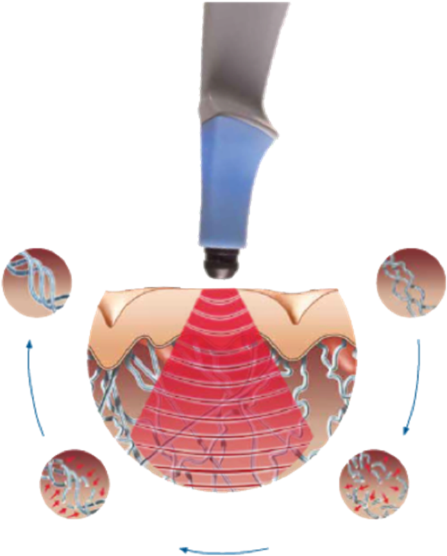 exilis ultra 360 effects