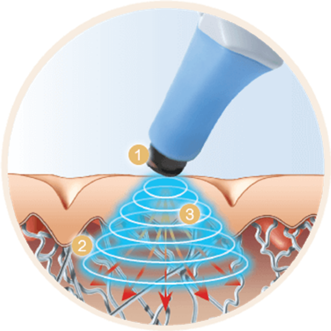 exilis ultra 360 technology