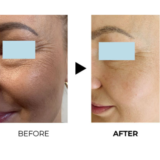 juvelook before after