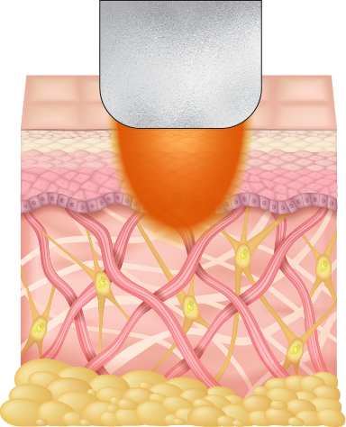 soprano titanium shr mode