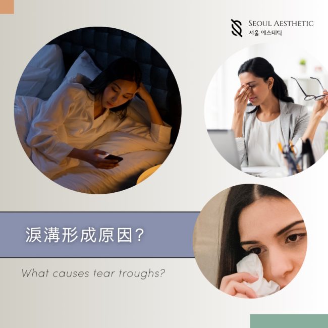 what are tear trough