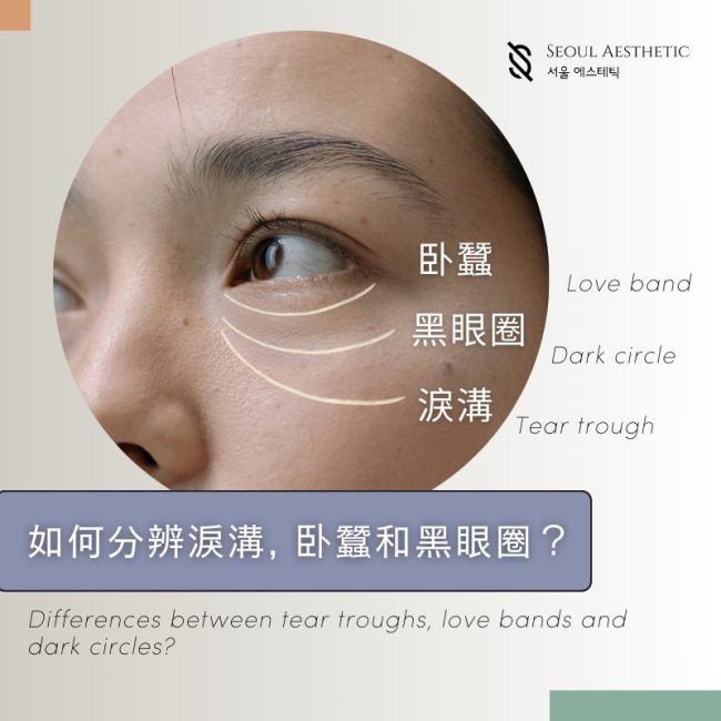 What causes tear troughs?