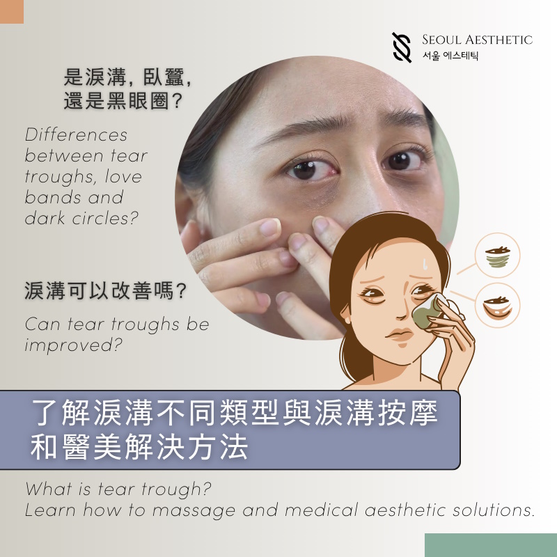 Tear Trough Correction