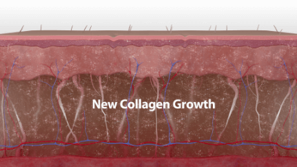 how thermage FLX works (step 4)