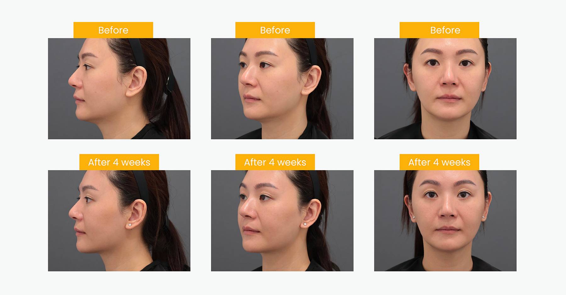 ultherapy prime before after
