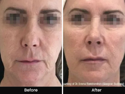 Face Rejuvenation