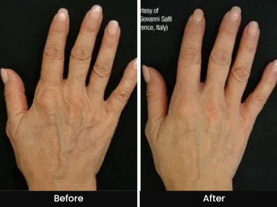Hand Rejuvenation