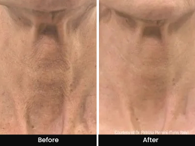 Reduce neck line